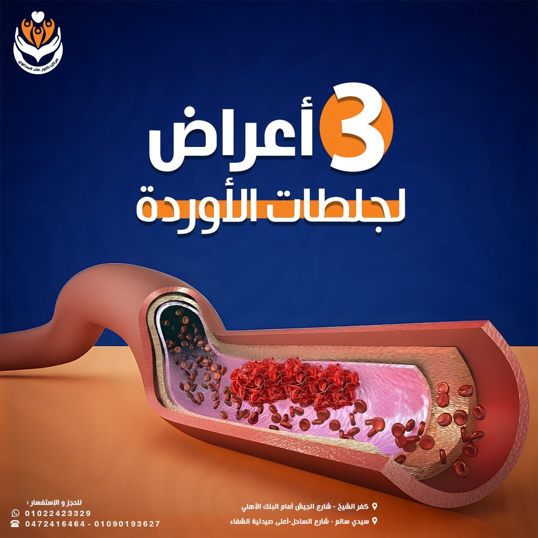 3 Symptoms Of Venous Clots